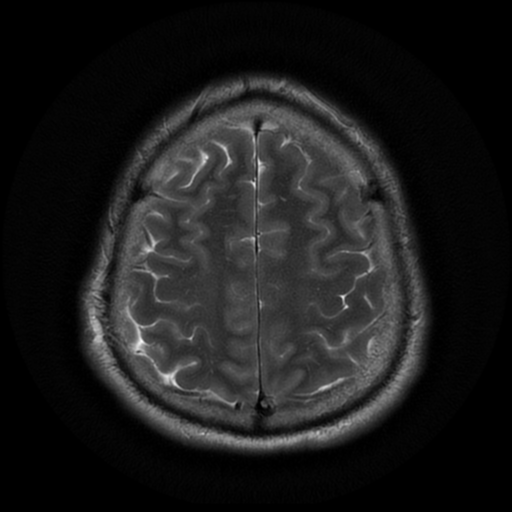 File:Aqueduct stenosis with corpus callosum hypoattenuation post shunting (Radiopaedia 37212-38969 Axial T2 19).png