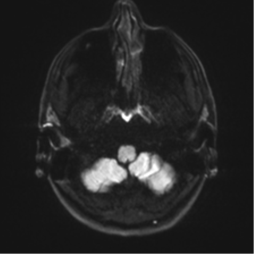 Arachnoid cyst - cerebellopontine angle (Radiopaedia 59689-67083 Axial DWI 40).png