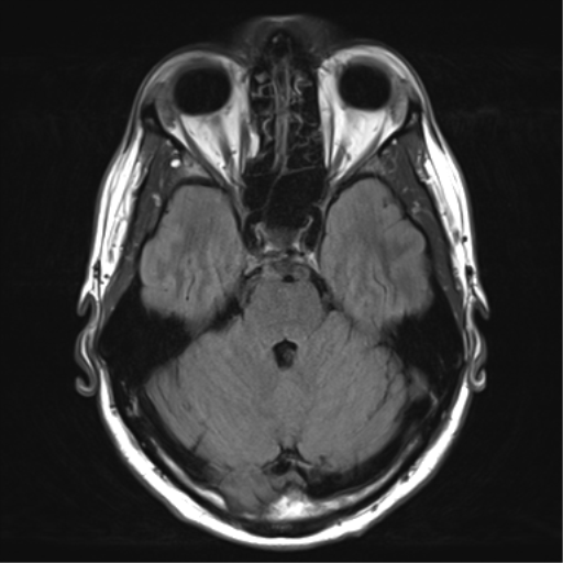 File:Arachnoid cyst - cerebellopontine angle (Radiopaedia 59689-67083 Axial FLAIR 12).png