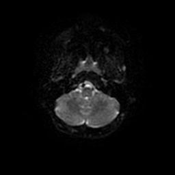 Arachnoid cyst - middle cranial fossa (Radiopaedia 67671-77088 Axial DWI 31).jpg