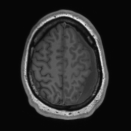 File:Arachnoid cyst with subdural hematoma (Radiopaedia 85892-101743 Axial T1 69).png