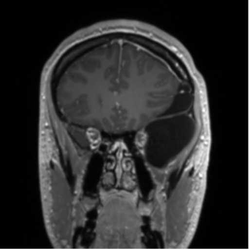 File:Arachnoid cyst with subdural hematoma (Radiopaedia 85892-101743 Coronal T1 C+ 68).png