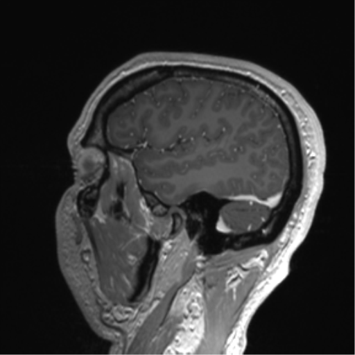 Arachnoid cyst with subdural hematoma (Radiopaedia 85892-101743 Sagittal T1 C+ 75).png