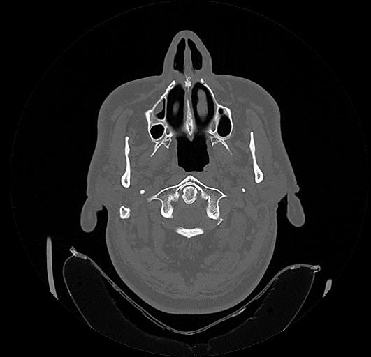 Arcuate foramen (Radiopaedia 89833-106944 Axial bone window 20).jpg