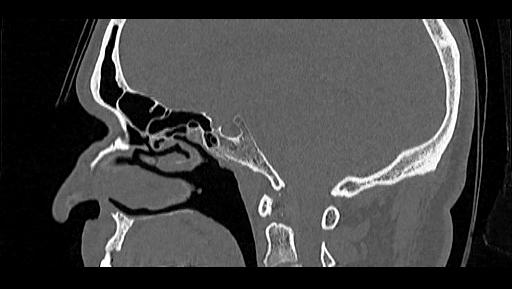 Arcuate foramen (Radiopaedia 89833-106944 Sagittal bone window 70).jpg