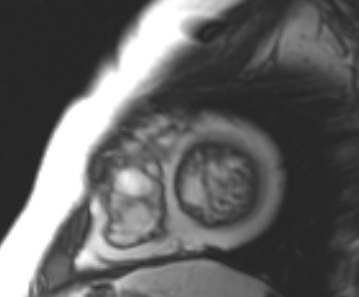 File:Arrhythmogenic right ventricular cardiomyopathy (Radiopaedia 69431-79307 Short axis cine 22).jpg