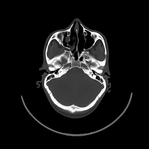 Arrow injury to the brain (Radiopaedia 72101-82607 Axial bone window 57).jpg