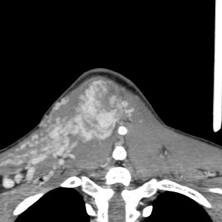 Arteriovenous malformation of the neck (Radiopaedia 53935-60062 D 52).jpg