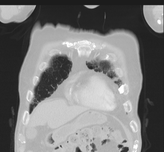 Asbestosis (Radiopaedia 56192-62864 Coronal lung window 10).png