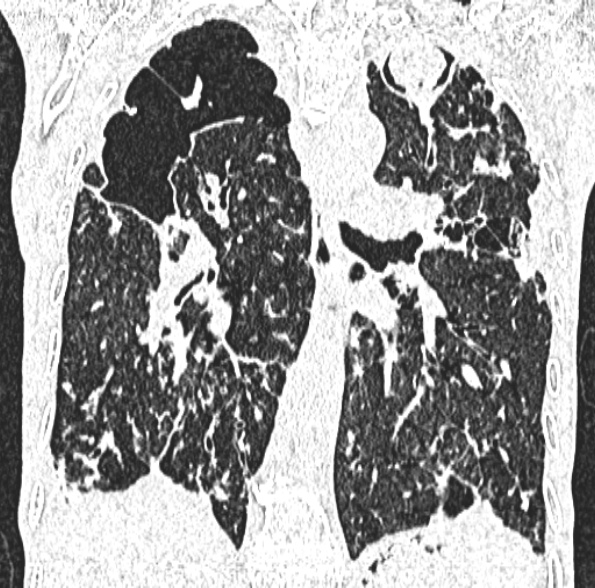 Aspergilloma- with Monod sign (Radiopaedia 44737-48532 Coronal lung window 281).jpg