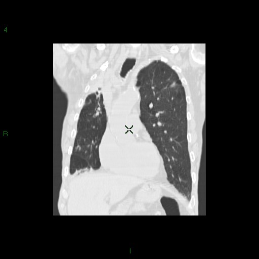 File:Aspergilloma (Radiopaedia 14842-14787 Coronal lung window 13).jpg