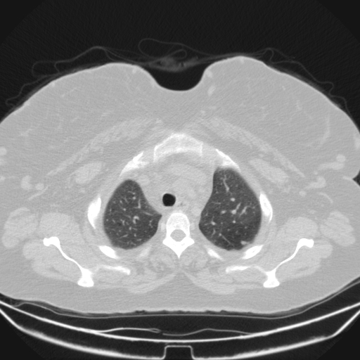 Aspergilloma (Radiopaedia 39611-41932 Axial lung window 18).jpg