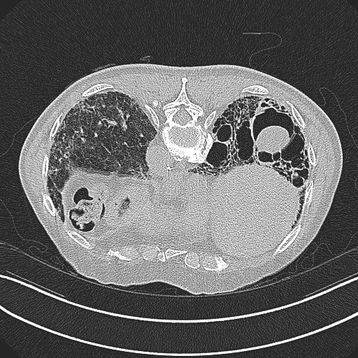File:Aspergilloma on background pulmonary fibrosis (Radiopaedia 60942-68757 Axial lung window 24).jpg