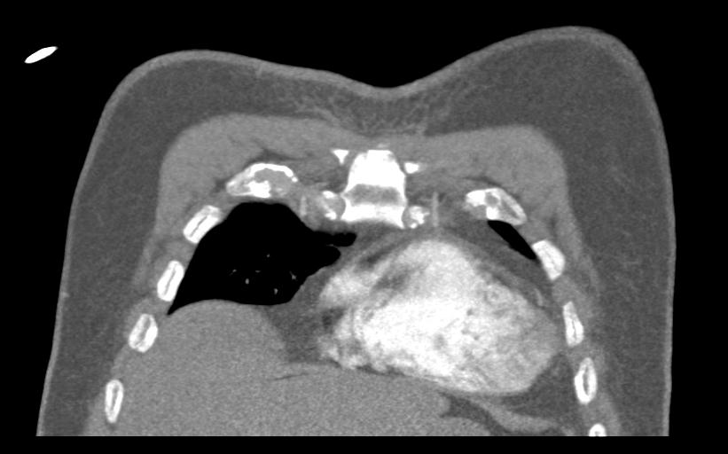 Aspirated tooth (Radiopaedia 28584-28844 Coronal C+ CTPA 14).jpg