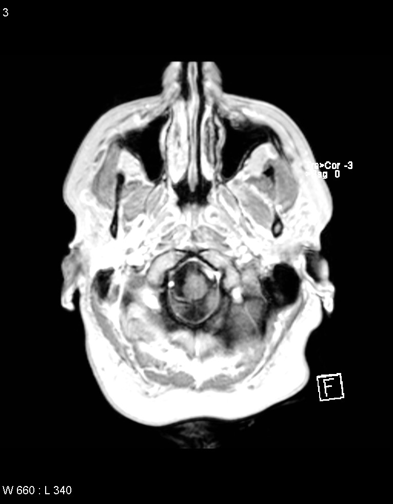 Astroblastoma (Radiopaedia 39792-42218 Axial T1 C+ 2).jpg