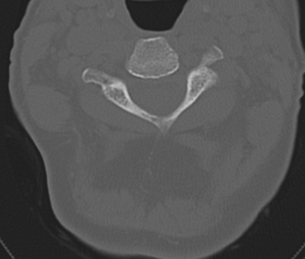 Atlanto-axial subluxation (Radiopaedia 36610-38176 Axial bone window 20).png