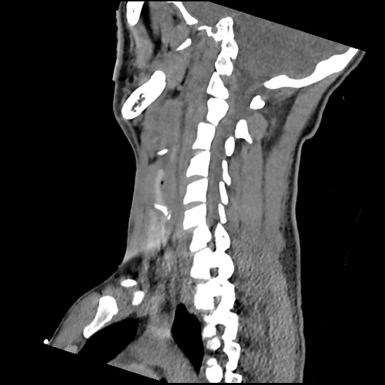 File:Atlanto-occipital dissociation (Traynelis type 1), C2 teardrop fracture, C6-7 facet joint dislocation (Radiopaedia 87655-104061 D 52).jpg