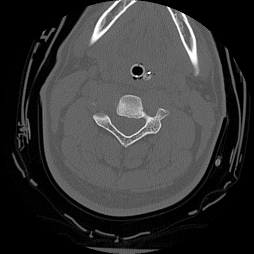 Atlanto-occipital dissociation injury (Radiopaedia 29274-29698 Axial bone window 33).png