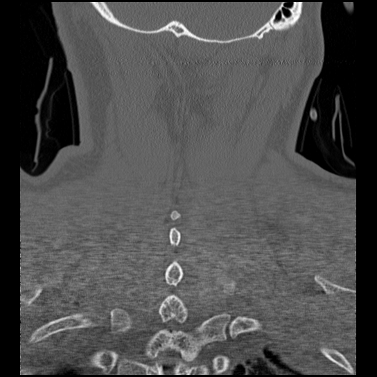 Atlanto-occipital dissociation injury (Radiopaedia 29274-29698 Coronal bone window 6).png