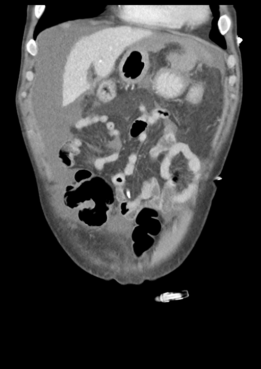 Atraumatic splenic rupture (Radiopaedia 42931-46160 B 14).png