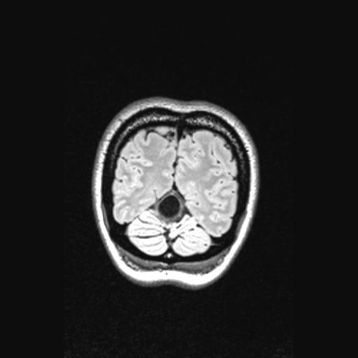 File:Atretic encephalocoele with inferior vermis hypoplasia (Radiopaedia 30443-31108 Coronal FLAIR 30).jpg