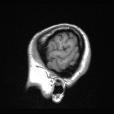 File:Atretic encephalocoele with inferior vermis hypoplasia (Radiopaedia 30443-31108 Sagittal T1 6).jpg