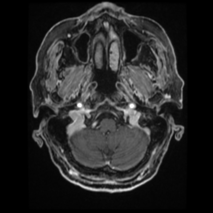 Atypical meningioma (Radiopaedia 45535-49629 Axial T1 C+ 19).jpg