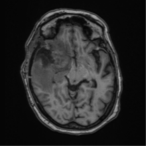 Atypical meningioma (WHO Grade II) (Radiopaedia 54742-60981 Axial T1 30).png