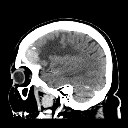 Atypical meningioma (WHO grade II) with brain invasion (Radiopaedia 57767-64728 Sagittal C+ 13).png