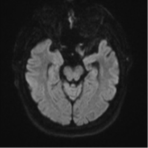 File:Atypical meningioma (WHO grade II) with brain invasion (Radiopaedia 57767-64729 Axial DWI 41).png
