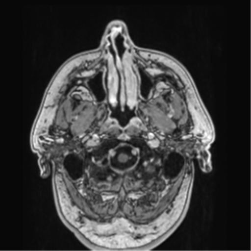 File:Atypical meningioma (WHO grade II) with brain invasion (Radiopaedia 57767-64729 Axial T1 C+ 2).png
