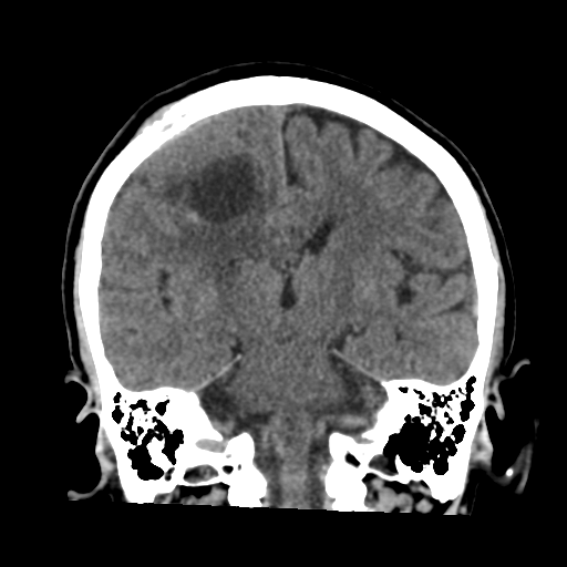 Atypical meningioma (WHO grade II) with osseous invasion (Radiopaedia 53654-59715 Coronal non-contrast 37).png