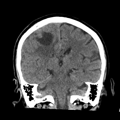 Atypical meningioma (WHO grade II) with osseous invasion (Radiopaedia 53654-59715 Coronal non-contrast 39).png