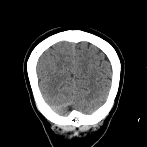 Atypical meningioma (WHO grade II) with osseous invasion (Radiopaedia 53654-59715 Coronal non-contrast 54).png