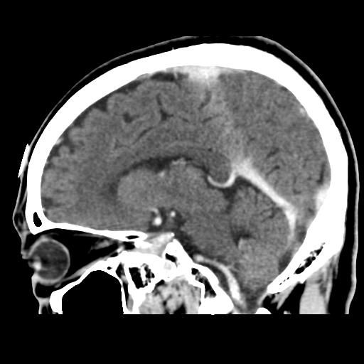 Atypical meningioma (WHO grade II) with osseous invasion (Radiopaedia 53654-59715 G 31).png