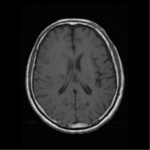 File:Atypical meningioma (WHO grade II) with osseous invasion (Radiopaedia 53654-59716 Axial T1 13).png
