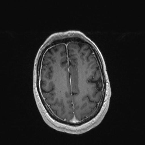 Atypical meningioma (grade II) - en plaque (Radiopaedia 29633-30147 Axial T1 C+ 141).jpg