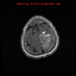 File:Atypical meningioma - grade II (Radiopaedia 13303-13305 Axial FLAIR 20).jpg