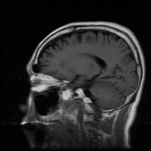 File:Atypical meningioma with skull invasion (Radiopaedia 34357-35648 Sagittal T1 9).png