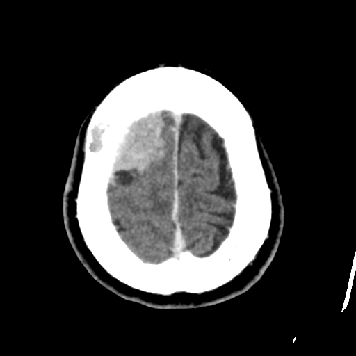 File:Atypical meningioma with skull invasion (Radiopaedia 34357-35649 Axial C+ delayed 46).png