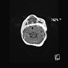 Atypical teratoid rhabdoid tumor (prenatal US and neonatal MRI) (Radiopaedia 59091-66388 Axial T1 1).jpg