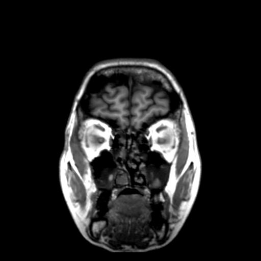 Autoimmune limbic encephalitis (Radiopaedia 30363-31005 Coronal T1 49).jpg