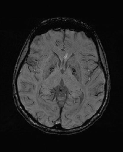 Autoimmune limbic encephalitis (Radiopaedia 30363-31005 SWI 38).jpg