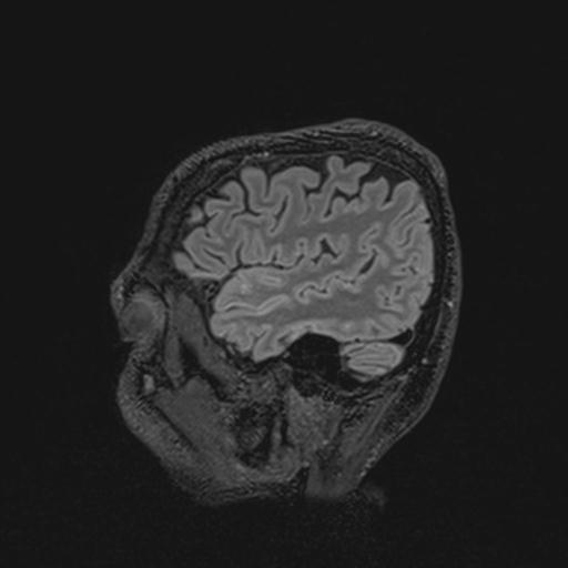 Autoimmune limbic encephalitis (Radiopaedia 30363-31005 Sagittal FLAIR 35).jpg