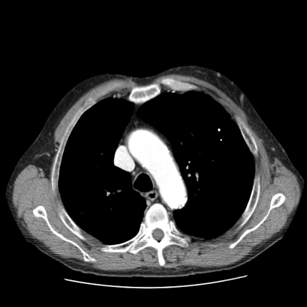 Autosomal dominant polycystic kidney disease (Radiopaedia 27851-28094 B 19).jpg
