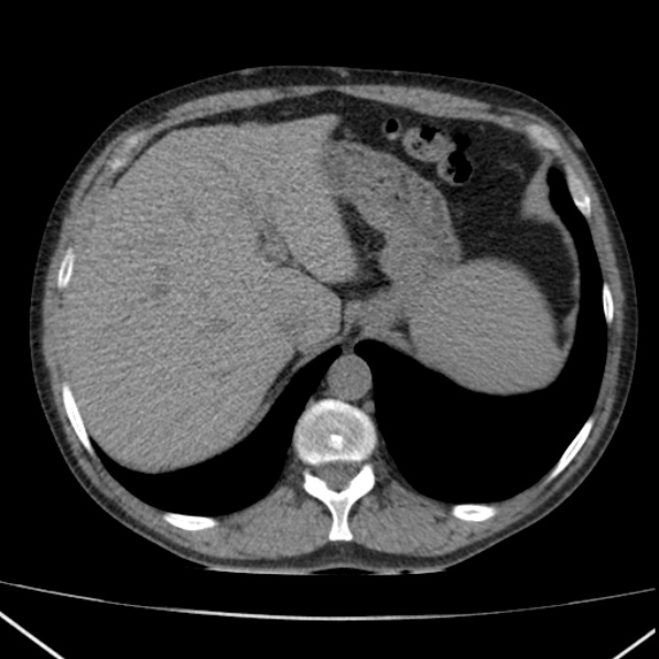 File:Autosomal dominant polycystic kidney disease (Radiopaedia 36539-38101 Axial non-contrast 16).jpg