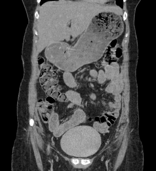 File:Autosomal dominant polycystic kidney disease (Radiopaedia 38189-40194 Coronal C+ delayed 16).jpg
