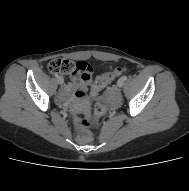 Autosomal dominant polycystic kidney disease - early onset (Radiopaedia 40734-43387 A 72).jpg