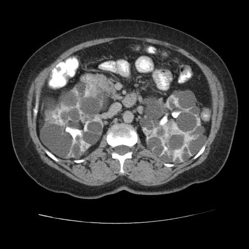 Autosomal dominant polycystic kidney disease with hepatic involvement (Radiopaedia 32693-33662 C 32).jpg