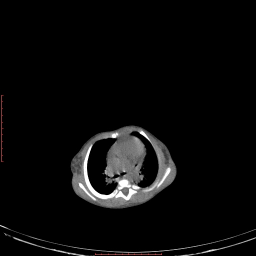 Autosomal recessive polycystic kidney disease associated with Caroli disease (Radiopaedia 61932-69984 Axial non-contrast 45).jpg